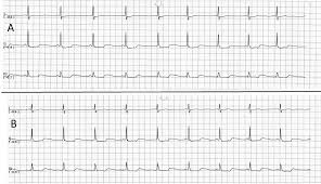 An atrial arrhythmia that occurs when the natural cardiac pacemaker site shifts between the sinoatrial node (sa node), the atria, . Ecgrhythms Twitter à¤ªà¤° The Wandering Pacemaker Https T Co G9tw3wv8xm Foamed Foamems Meded Ecg Ecgchat Ise Telemetry Https T Co 46xwsv229o Twitter