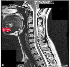 Pin On Fibromyalgia