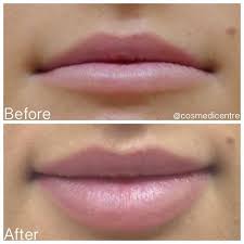 Cosmetic Injectables Coffs Harbour Gold Coast Grafton Juvederm Lips Lip Augmentation Cosmetic Injectables