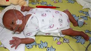 Kinder, die vor der 28.ssw. Fruhchen Wog Bei Geburt Nur 275 Gramm Und Hat Uberlebt