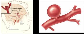 Um aneurisma cerebral, é um ponto fraco em uma artéria cerebral. Tratamento Endovascular De Aneurisma Cerebral Dr Eduardo F Raupp