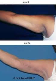 Lifting du visage en tunisie. Tarif Prix Du Lifting De Bras Dr Yohann Derhy Paris