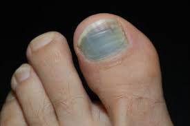 Since toenail fungus can look like other conditions, including psoriasis, you'll want to have your toenail take a good look at your nail beds and the skin around your toenails regularly, at least once a month. Causes Symptoms Of Black Toenails Dallas Podiatry Works