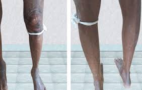 Image result for Perthes Test