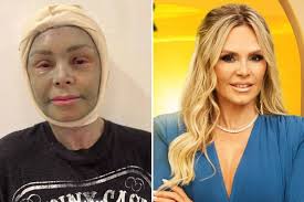 RHOC's Tamra Judge looks completely unrecognizable with swollen face and  'crusty' skin after major plastic surgery