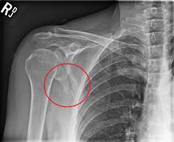 Image result for Shoulder XRay