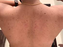 Clean sheets and pillowcases are essential for clearing back acne. Acne Help With Back Acne Scars Skincareaddiction