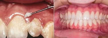 Jun 02, 2019 · removing tartar with hydrogen peroxide (in form of 3% solution) this ingredient is effective in plaque removal as well as teeth whitening (in higher concentrations), but it's not effective in tartar removal. How To Use One Correctly Which Model To Buy And How It Compares To Flossing Waterpiks