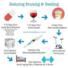 Sanctuarymedicalcenterboca Posted To Instagram If Bruising And Swelling Are Concerns For You After Your Botox And Filler Appointmen Botox Swellings Restylane