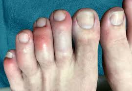Cancer.net reported that swelling or fluid buildup in the legs or feet could be a sign that prostate cancer has spread outside the prostate gland. Are Covid Toes And Rashes Common Symptoms Of The Coronavirus Health Essentials From Cleveland Clinic