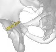 Pelvic Plating System | Acumed