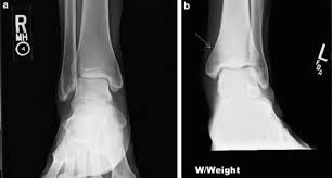 Anteroposterior and lateral radiographs of the ankle showing an oblique fracture of the fibula just above the level of the tibiofibular syndesmosis accompanied by soft tissue swelling. Stress Fractures Of The Ankle Musculoskeletal Key