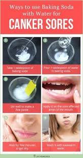 Baking Soda With Water For Canker Sores Naturalhealingforcancer Canker Sore Cankers Canker Sore Remedy