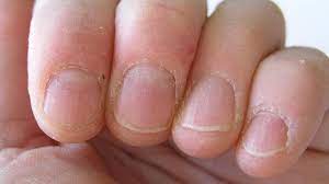 Check spelling or type a new query. Is The Skin Around Your Nails Peeling Know The Causes Treatment And More Health Hindustan Times