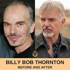 Billy Bob Thornton Haartransplantatie