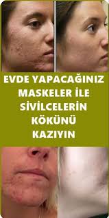 Sivilce Izlerini Geciren Dogal Maskeler Sivilce Izi Cilt Urunleri Maskeler