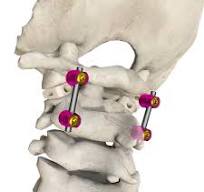 Posterior occipital-cervical-thoracic spinal system