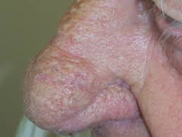 Das rhinophym kann nur durch abtragen der überschießenden wucherungen behandelt werden, was mit dem skalpell oder mit elektroresektion geschehen kann. Rhinophyma Dermnet Nz