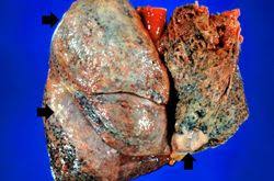 Mesothelioma cancer cells are in the sac lining the chest (pleura) or the abdomen (peritoneum). Iplab Lab 12 Thoracic Mesothelioma Pathology Education Instructional Resource