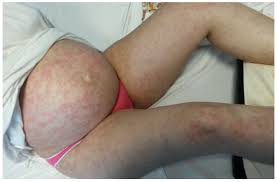 Image result for pruritic urticarial papules and plaques of pregnancy
