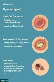 The most common types of skin cancer are: Pin On Skin Care