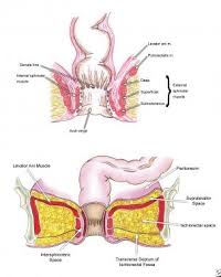 Image result for anal fistula