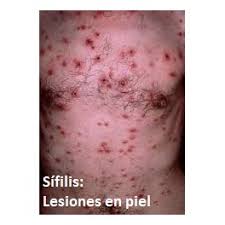 Sifilis Y Ronchas En El Pene Tratamiento Drenlinea