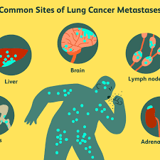 It is similar to a pet scan, but it uses a different radioactive substance that settles in areas of change in the bones. Where Does Lung Cancer Spread Verywell Health