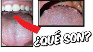Llagas Al Fondo De La Lengua Pepitas En La Lengua Que Son Youtube