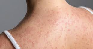 It's a "matter of time" before Pittsburgh sees measles cases, doctor says