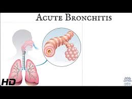 Image result for Acute Bronchitis