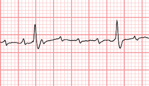 Practice Ecg Interpretation