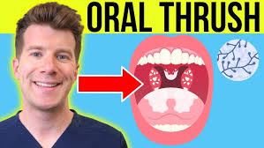 Image result for Oral thrush roof of mouth