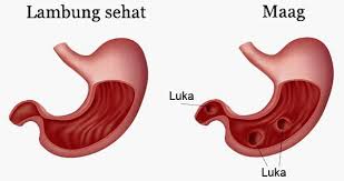 Lapisan dinding gaster terdiri dari tunica mucosa, tunica muskularis dan tunica mukosa vaskularisasi lambung berasal dari arteri gastrica sinistra yang berasal dari truncus coeliacus, arteri gastric dekstra yang merupakan cabang dari Gejala Penyebab Dan Obat Sakit Maag Analisa 6