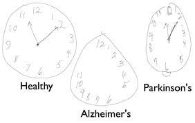 30 drawing yes 1:00, 3:00, 9:15, 7:00 subject asked to denote four different times. Detecting Alzheimer S Disease By Drawing A Clock Face With A Digital Pen Neuroscience News