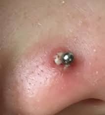 My Nose Piercing Got Infected After Being Ripped Out At New Year My Friend Said To Post Here Popping