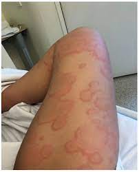 After the 7 day course was up, i started breaking out in extremely itchy hives a day later. Clinical Practice Guidelines Serum Sickness And Serum Sickness Like Reactions Sslrs