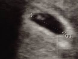 Maybe you would like to learn more about one of these? Is It Possible To Miss A Twin At 6 Week Scan