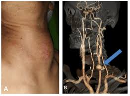 A blockage in one of the carotid arteries can be cleared either by endarterectomy or carotid angioplasty. Reconstruction Of Carotid Artery Pseudoaneurysm In An Intravenous Drug User With Multiple Needles In The Neck
