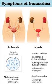 Image result for gonorrhea symptoms
