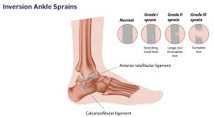 Anterior talofibular ligament (atfl) injury is the most common of the ligament injuries that can occur as part of the lateral ligament complex injuries 2. Beyond Tape Inversion Ankle Sprains Rock And Ice Magazine
