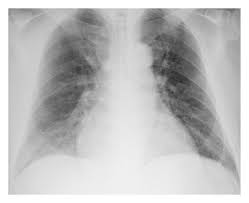Chest X Ray Shows Cardiomegaly And Pulmonary Vascular Congestion Download Scientific Diagram