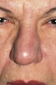 Dermabrasion, which removes excess layers of skin. Rhinoplasty In Patients With Thick Skin Ento Key