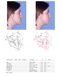 Maybe you would like to learn more about one of these? Corrective And Orthognathic Jaw Surgery Dr Richard W Joseph