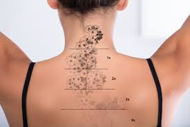 9 Tips For Effective Tattoo Removal Healing Better Off