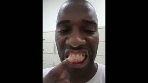 How to remove dental cement at home! Debonding Finished Scraping Braces Glue Off Teeth Youtube