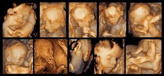 Ultrasound Dimensions Ultrasound Sonography 4d Ultrasound