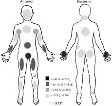 Image result for scabies effects on the human body