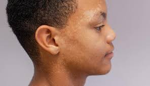 Bệnh lang ben có lây không? Cách điều trị và phòng ngừa