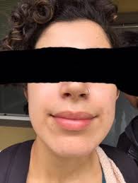 Lots of these scary cases of vit a toxicity are due to very high levels of retinol and low levels of vitamin d. Fungal Acne And Malassezia Warriors Listen Up Sample Routines